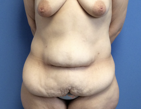 Tummy-Tuck--Case-Study-4187 | Before Body
